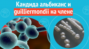 ? Кандида альбиканс и guilliermondii на члене. Клинический случай №1118