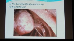 16 Полиглоттов ОВ Эндоскопическая папиллэктомия