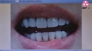 До и После. Керамические виниры в клинике ЗУУБ.РФ