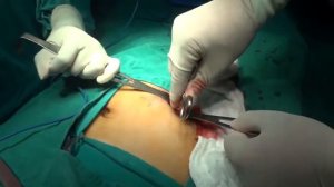 Аппендэктомия