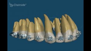 Как работает брекетсистема