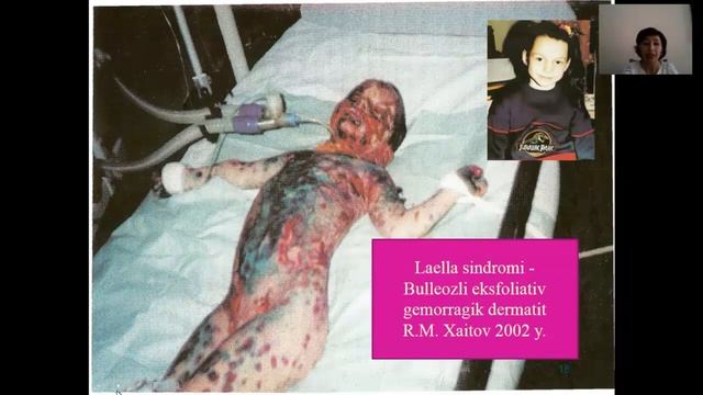 Ўткир аллергик реакциялар Анафилактик шок Квинке шиши смотреть онлайн