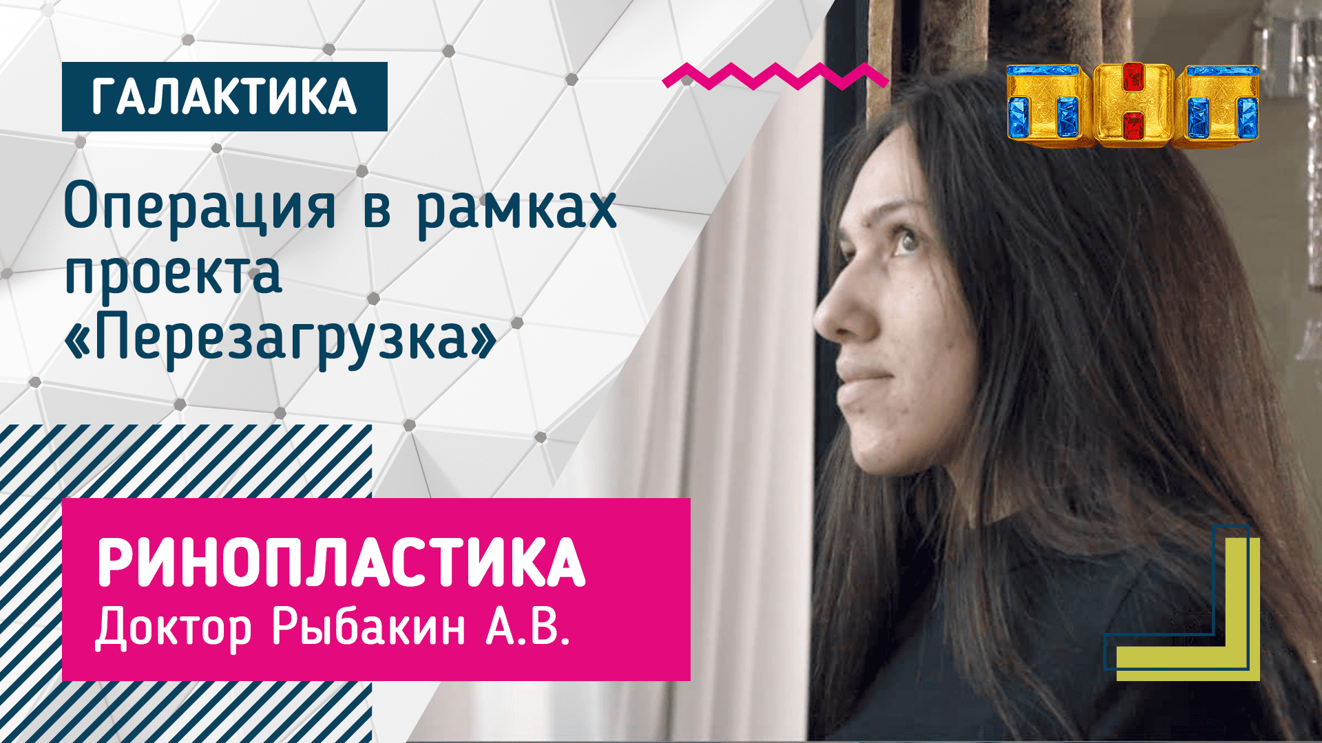 Ринопластика после аварии | Рыбакин Артур Владимирович #ринопластика #пластиканоса
