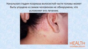 Псориаз на голове