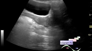 Детское ургентное УЗИ малого таза - Изменения правого яичника