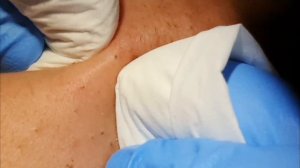 BIG BLACKHEADS EXTRACTIONS on Happy :)  #2