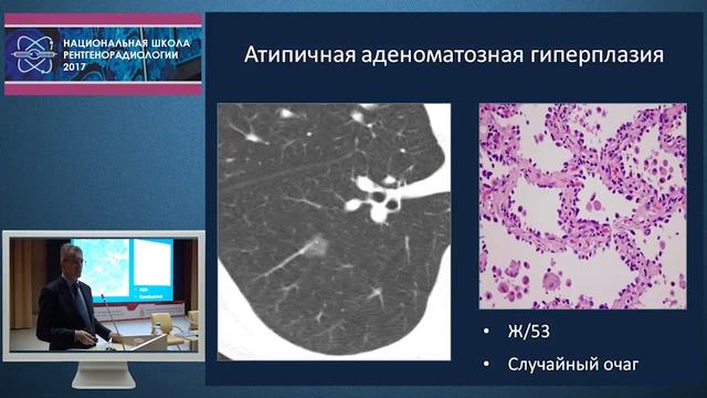 И.Е. Тюрин - Визуализация аденокарциномы легкого
