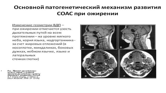 Гормоны под прицелом. Синдром обструктивных апноэ во сне и ожирение