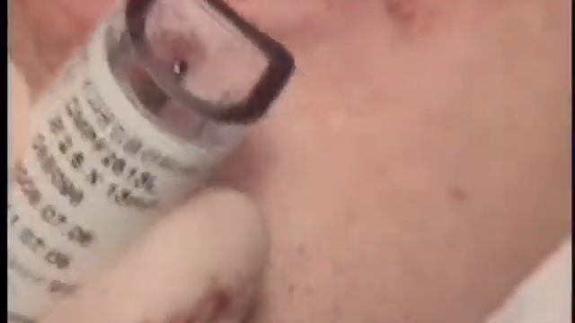 [DENTIS Implant] Immediate Provisinalization using I-Fix Implantation смотреть онлайн