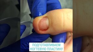 Коррекция вросшего ногтя СПб