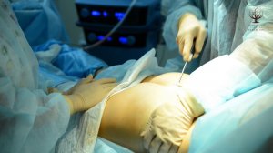 Липопластика VASER