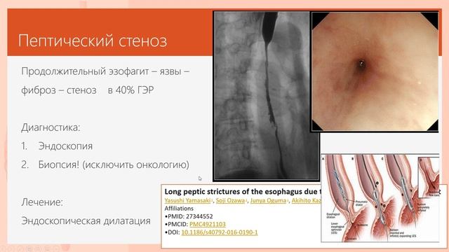 3. Гастроэзофагальный рефлюкс