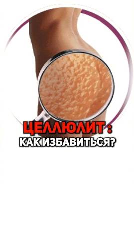 ЦЕЛЛЮЛИТ: КАК ИЗБАВИТЬСЯ? #диета #похудение #питание