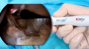 Якорный фиксатор Gryphon ProKnot