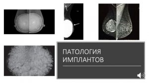 ЛЕКЦИЯ 2. МАММОГРАФИЯ  - ЛЮБОВЬ  С ПЕРВОГО ВЗГЛЯДА