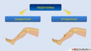 Тема 3 Понятие о переломах костей и их признаки, ушибы, вывихи, растяжение связок.