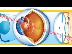 Катаракта. Опыт замены хрусталика по ОМС