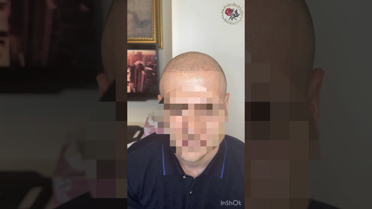 Загустили волосы после пересадки FUE! Трихопигментация Scalp micropigmentation SMP on FUE