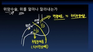 위암수술, 위를 얼마나 잘라내는가