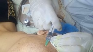 Чистка лица