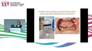 Рак слизистой оболочки полости рта. Реконструкция дефекта языка субментальным лоскутом