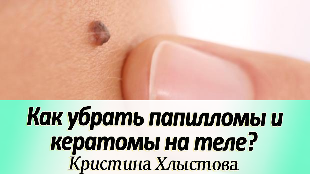 Как убрать папилломы и кератомы на теле ? | Кристина Хлыстова