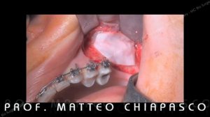 Система фиксационных хирургических пинов SUPERTACK