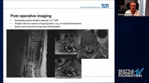 Surgical Management of Spine Tumors with Radiolucent Implants -  Bernhard Meyer, MD, PhD