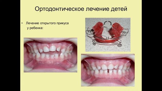 Прикус, окклюзия, артикуляция, методы определения, виды ретенции после ортодонтического лечения.