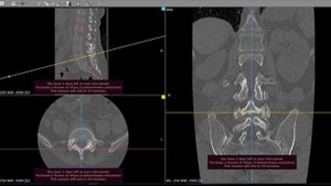 Эндоскопическая операция при стенозе позвоночника