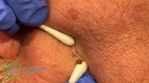 Birds Nest Blackhead | Dr. Derm