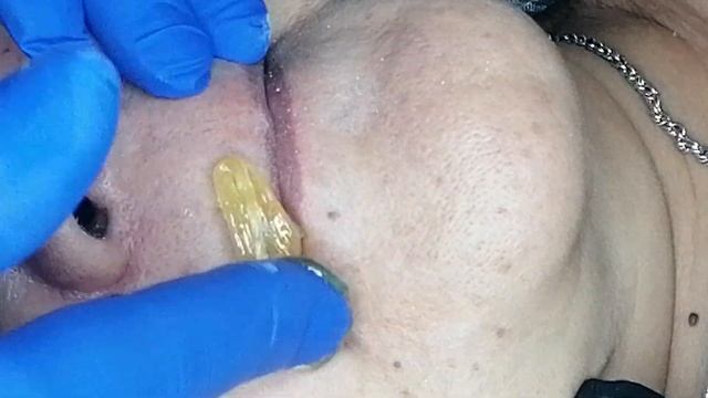 Шугаринг лица. Возрастные Женские усики.