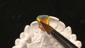 Коронки металлокерамические