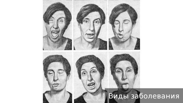 Хорея. Как лечить хорею. смотреть онлайн