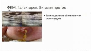 Массаж и ЛФК при фиброзной кистозной мастопатии
