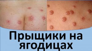 Прыщики на ягодицах