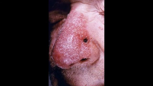 туберкулез смотреть онлайн