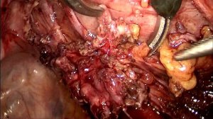 Удаление эндометриоидной кисты яичника, иссечение инфильтративного эндометриоза