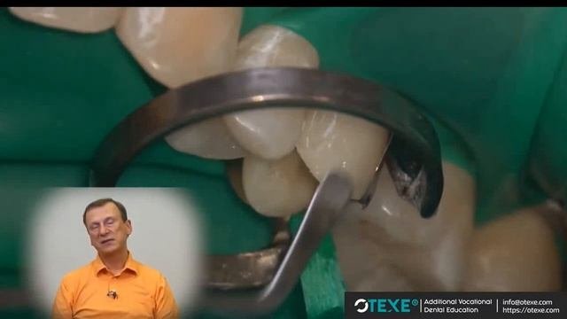 Радлинский   Бонус видео 2  Реставрация верхнего премоляра