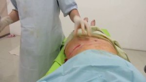 Липоксация живота и др.