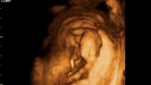 3D узи 13 недель смотреть онлайн