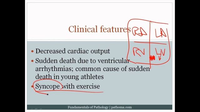 Pathoma USMLE - VIII ГЛАВА - Кардиомиопатии, опухоли сердца