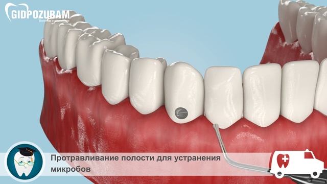 Лечение пришеечного кариеса: этапы лечения пришеечного кариеса