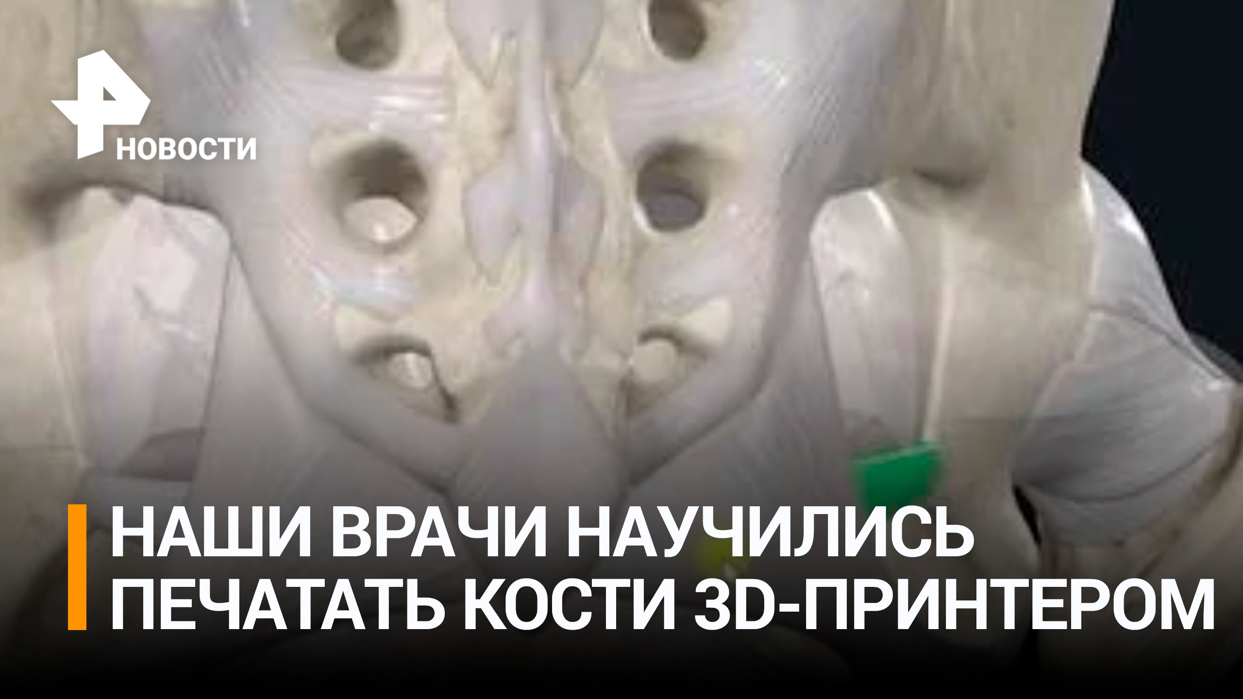 Российские ученые научились воссоздавать на 3D-принтере любые кости человека / РЕН Новости