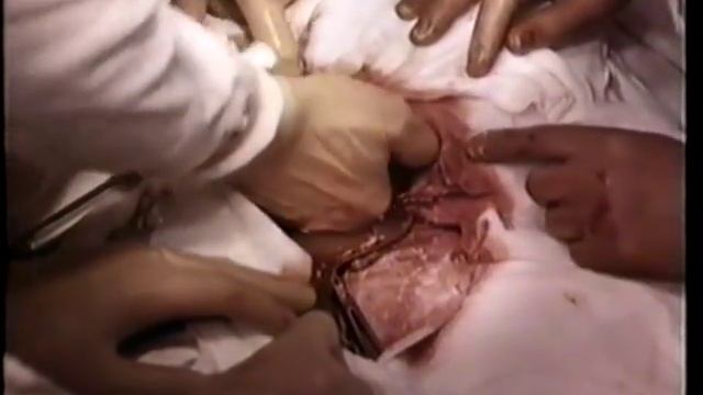 Кесарево сечение в нижнем маточном сегменте поперечным разрезом © Caesarean section in lower segmen