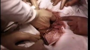 Кесарево сечение в нижнем маточном сегменте поперечным разрезом © Caesarean section in lower segmen