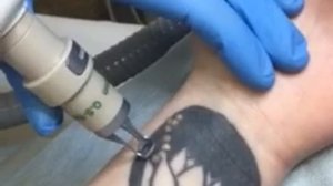Удаление татуировки лазером (продолжение)