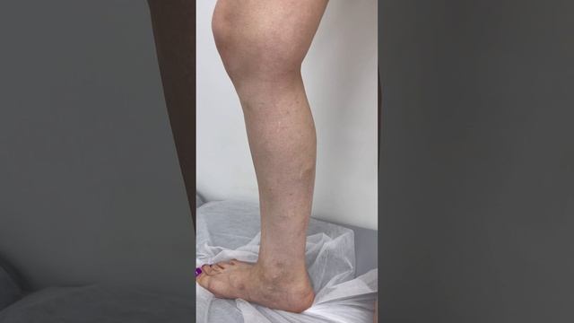 Варикоз после операции. Записаться на прием к флебологу в Москве, пишите в вацап 89250423646 смотреть онлайн