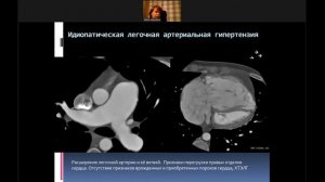 Мастера диагностики легочной гипертензии: все проще, чем кажется