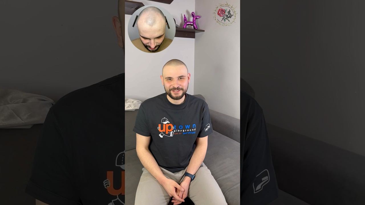 Изменился за 2 дня! Мотивация от клиента. Трихопигментация против облысения SMP